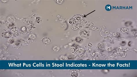 PUS Cells in Stool .
